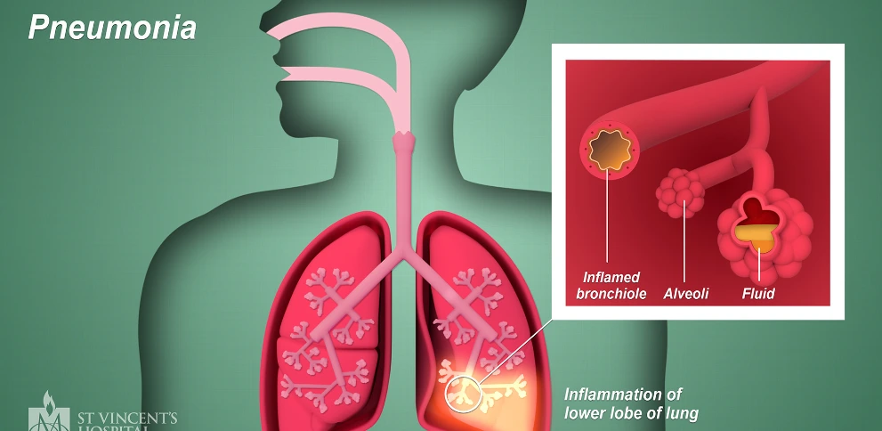 Pneumonia