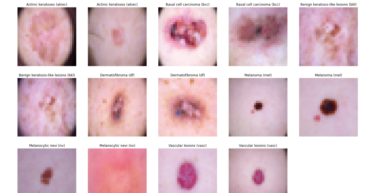 eda2 skin cancer dataset