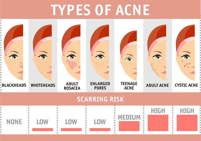 Types of Acne